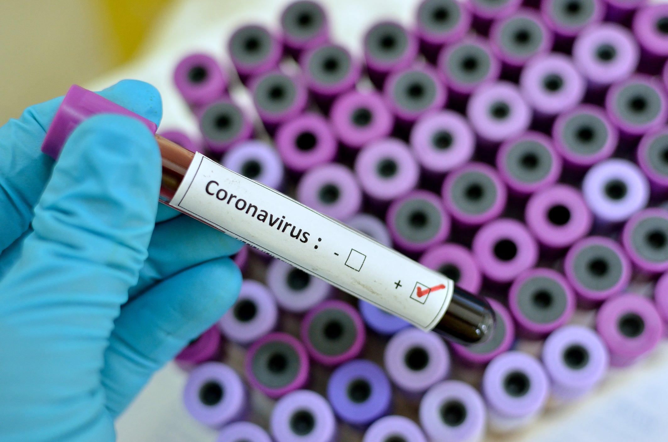 В Запорожье уже 76 человек заболело на COVID-19